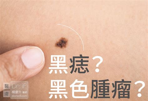 黑色的痣|不大驚小怪！如何辨別「黑痣」與「黑色腫瘤」？ 